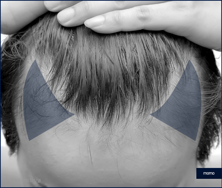 청소년 m자 탈모 요인 분석이 중요한 이유 관련 이미지 5