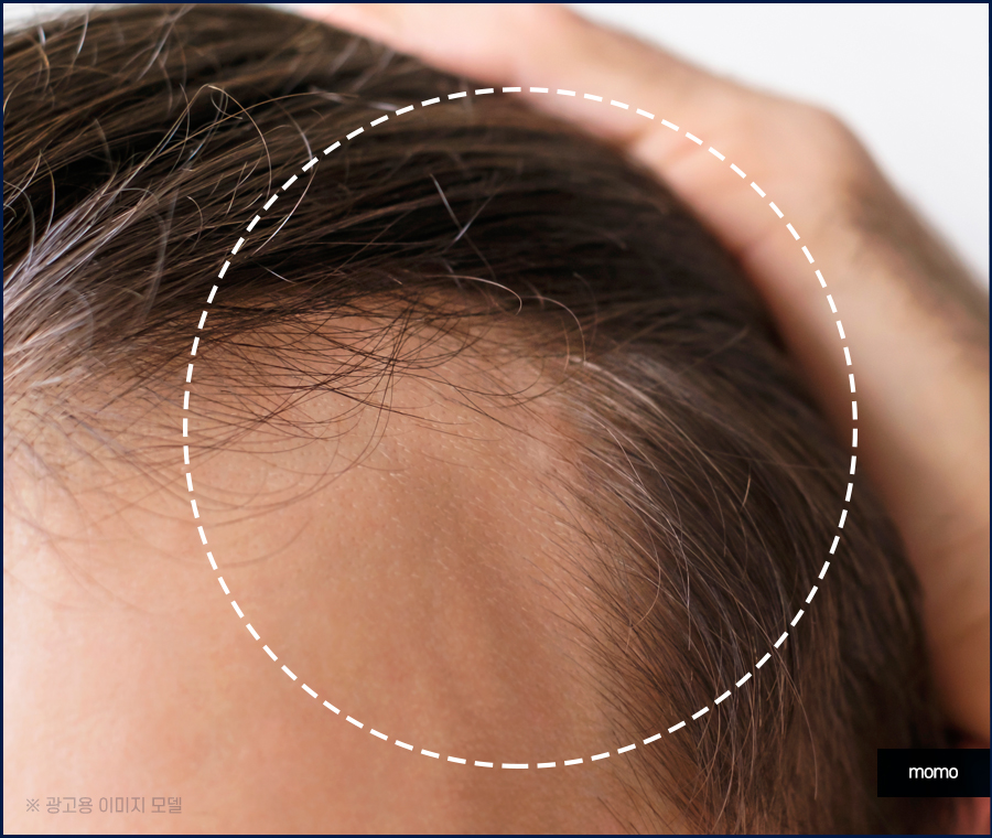 머리심기비용이 달라지는 이유와 차이점 관련 이미지 2