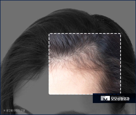 여자비절개모발이식 당당한 이마 라인을 뽐내도록 관련 이미지 5
