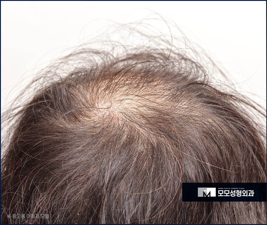 강남탈모병원 처치 방법에 대해 관련 이미지 3