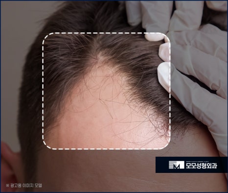 신사역 모발이식 디자인이 중요시 여겨지는 이유 관련 이미지 5