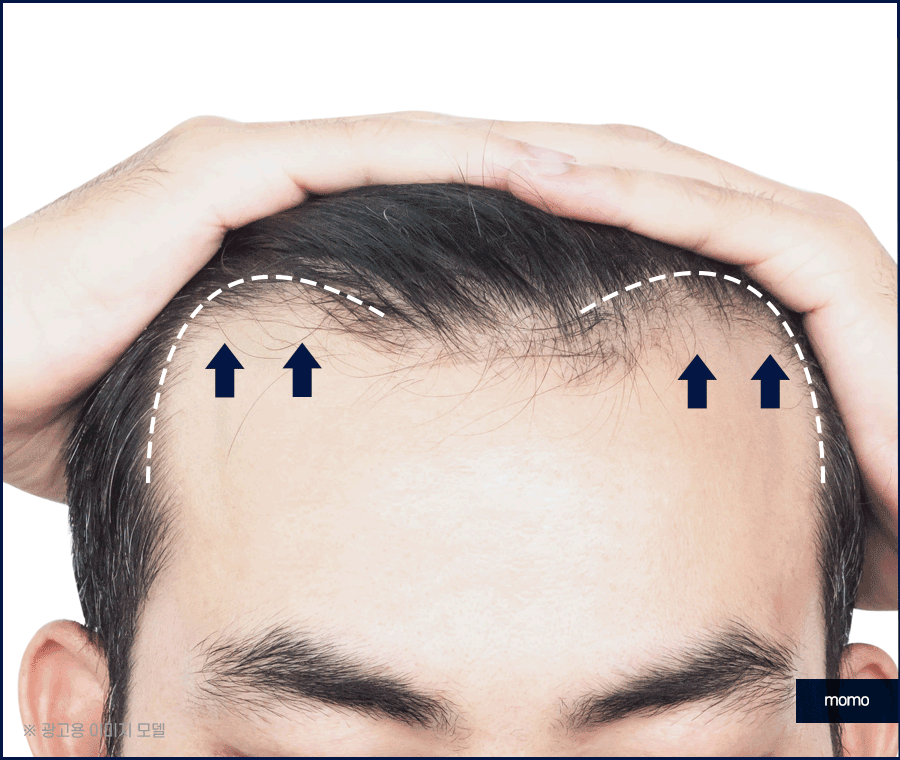 엠자 탈모 섬세하게 채워 만드는 변화 관련 이미지 10