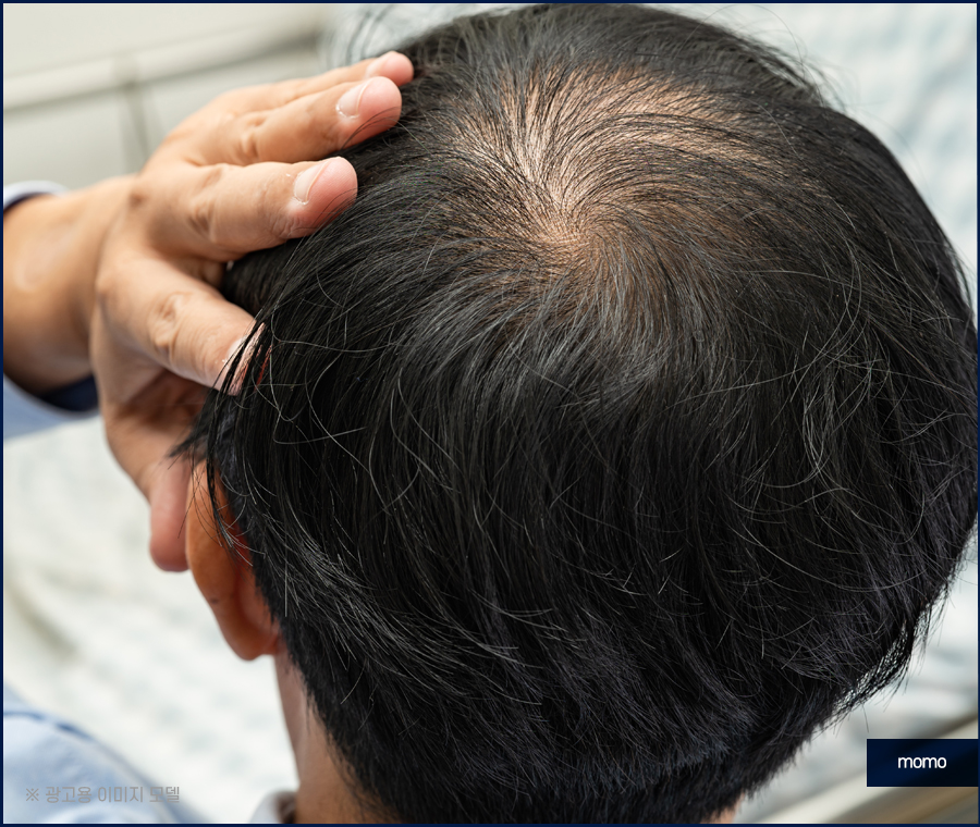 탈모약 부작용 증상 및 주의해야 할 사항 관련 이미지 5