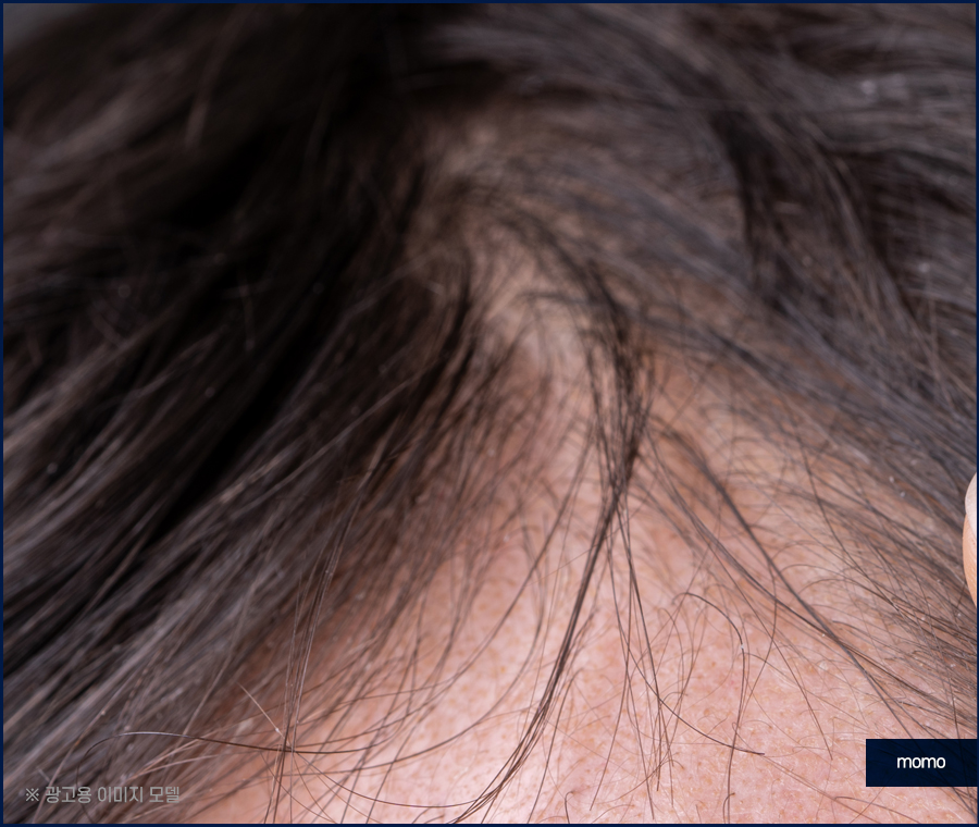 엠자이마 고민 탈출을 위한 모발이식 관련 이미지 4