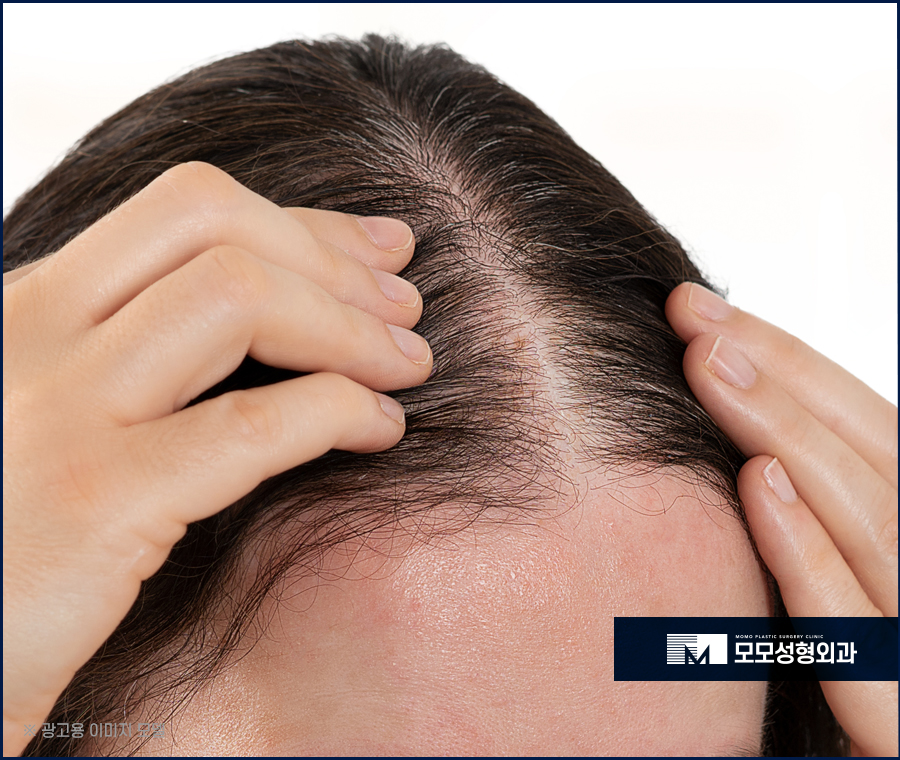 여자헤어라인모발이식 이마 높이 변화로 작은 얼굴 효과 관련 이미지 6