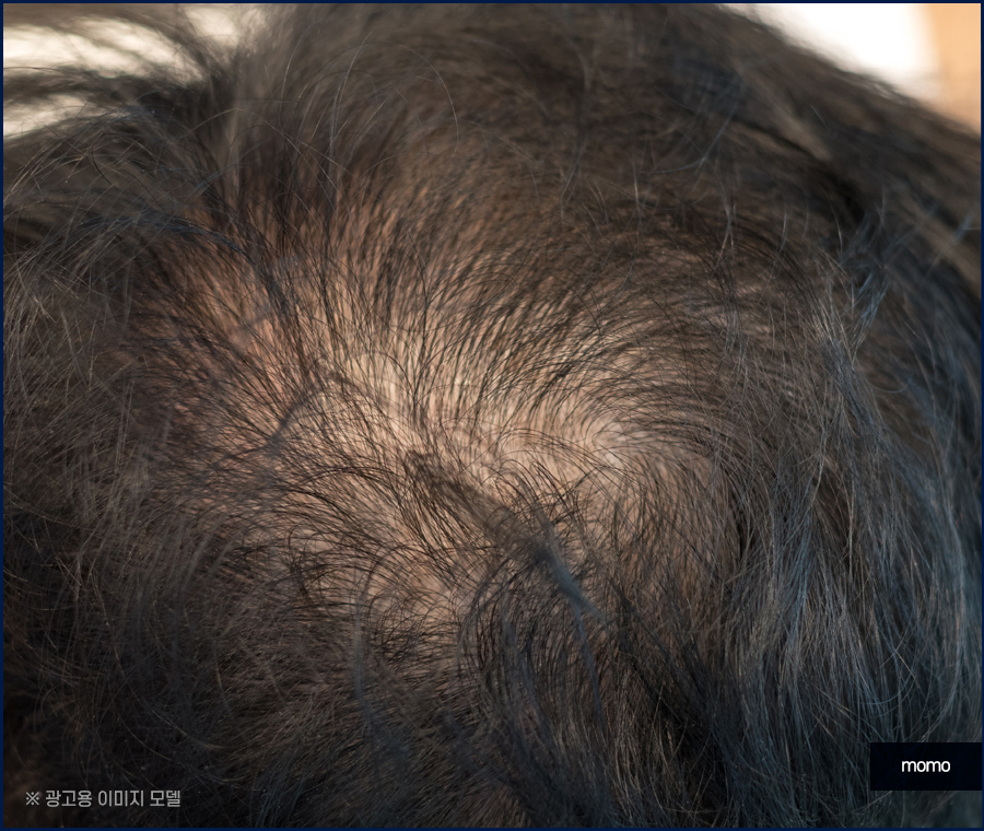 정수리 탈모 모발이식 섬세하게 채워가는 관련 이미지 10