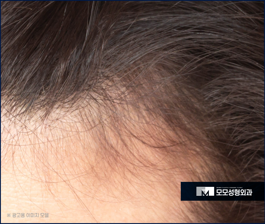 m자형 탈모 보완 시 꼭 짚어야 할 체크 포인트 (ft. 모발이식) 관련 이미지 3