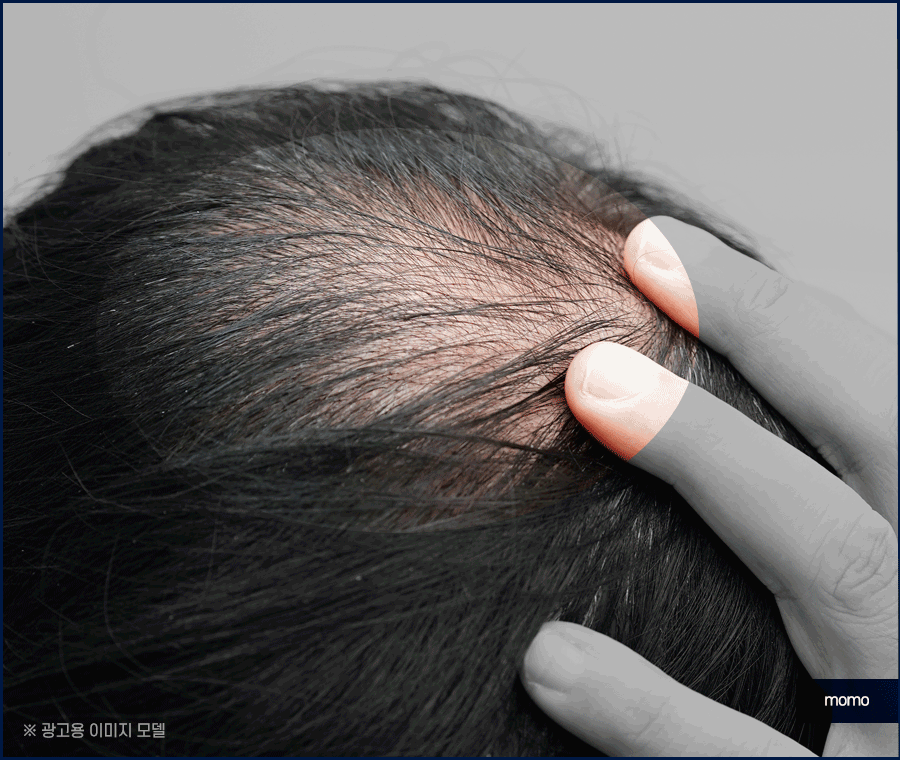 남자 탈모약으로 치료할 때 확인할 사항 관련 이미지 4
