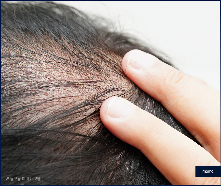 머리 간지러움 원인과 빠른 증상 해소를 위한 tip 관련 이미지 6