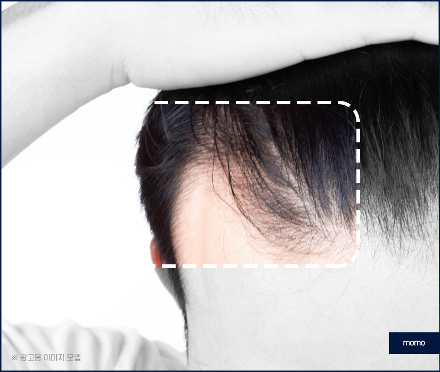 서울모발이식병원 나아지는 과정은 관련 이미지 8