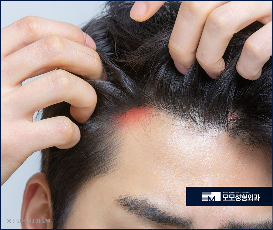 두피뾰루지원인 부터 조치하는 방법은 관련 이미지 3