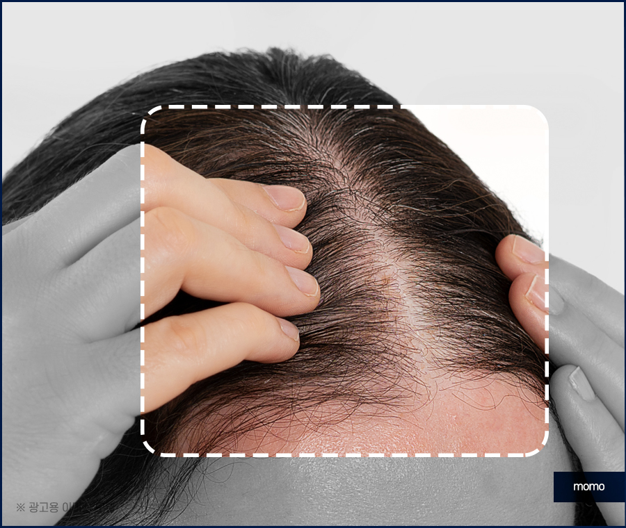 여성 모발이식 자연스러운 변화를 만드는 관련 이미지 6