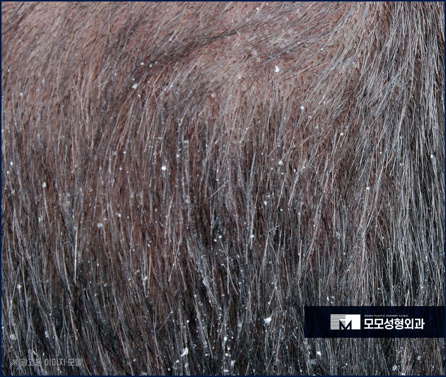 머리안감으면탈모 증상이 찾아올까요 진실은 관련 이미지 5