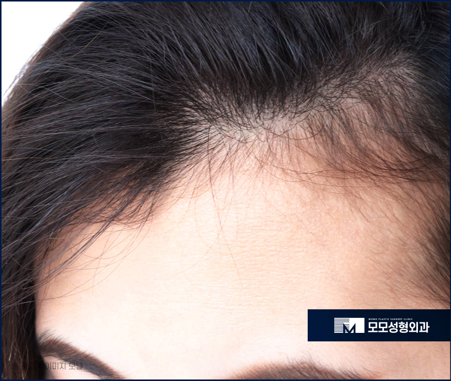 헤어라인 교정 비용 바라던 예후를 만들기 위한 관련 이미지 4