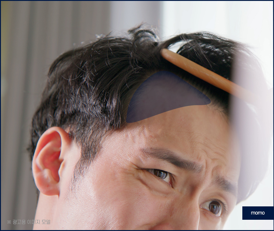 m자 모발이식 가격 달라지게 되는 이유는 관련 이미지 2
