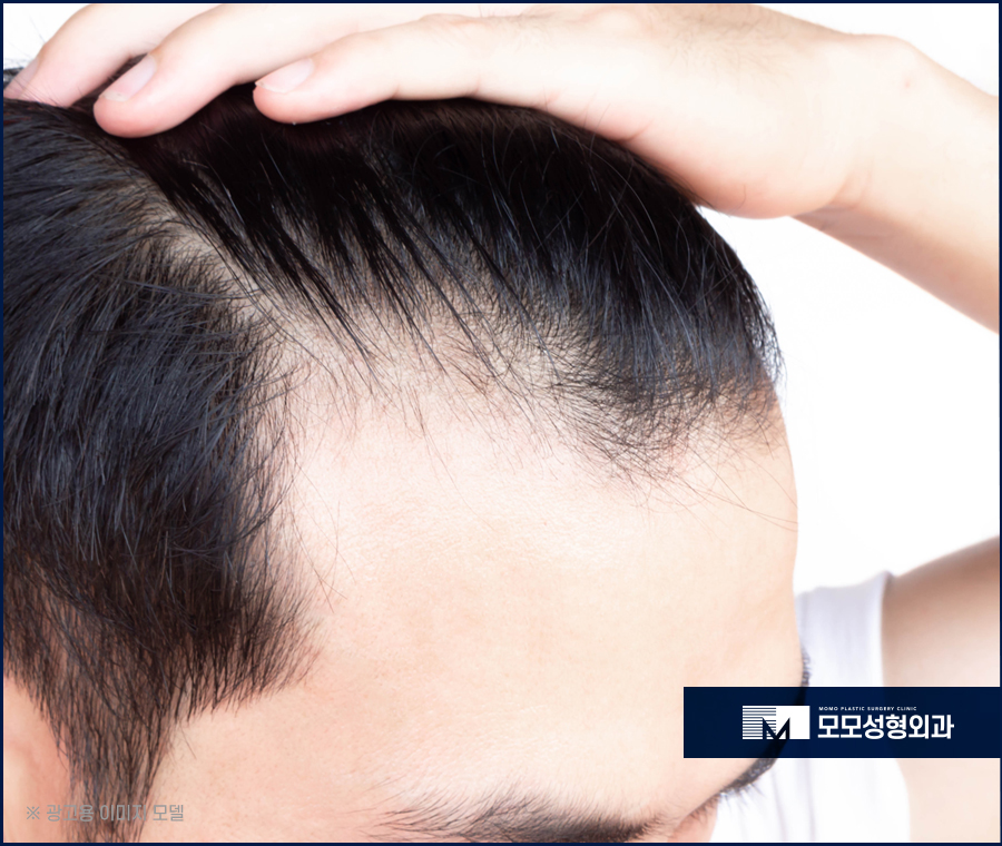 M자모발이식비용이 달라지는 기준과 방식의 차이에 대해 관련 이미지 4