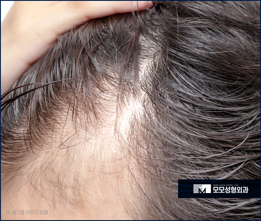 여자헤어라인모발이식 이마 높이 변화로 작은 얼굴 효과 관련 이미지 8