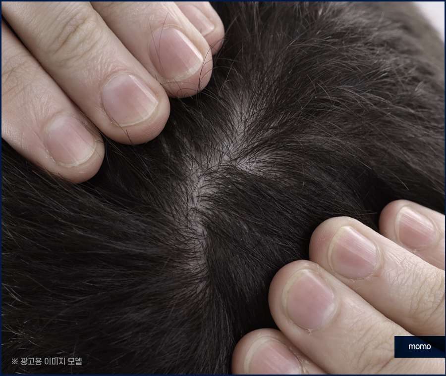 모발이식 생착률 극대화 하려면 관련 이미지 2