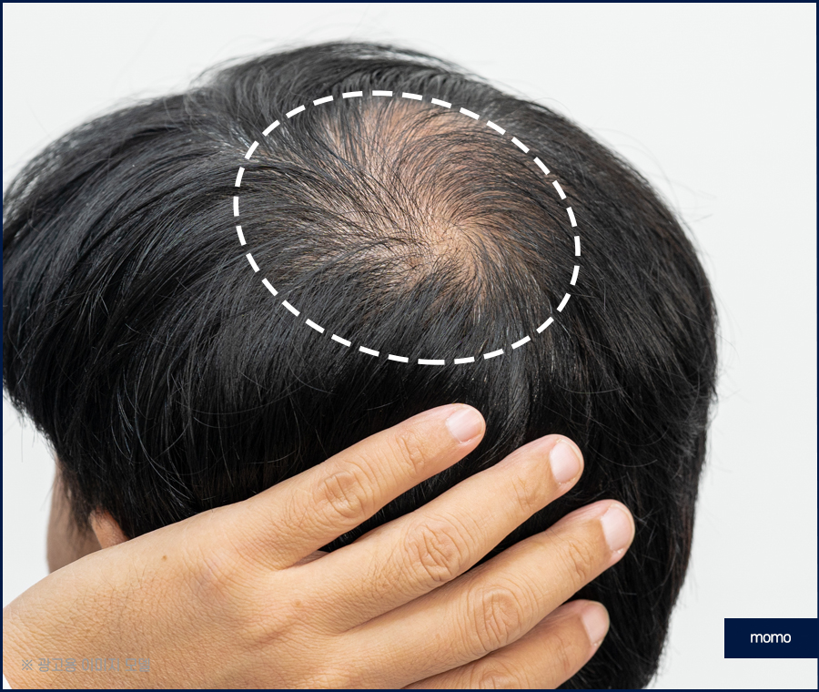 정수리 탈모 모발이식 섬세하게 채워가는 관련 이미지 7