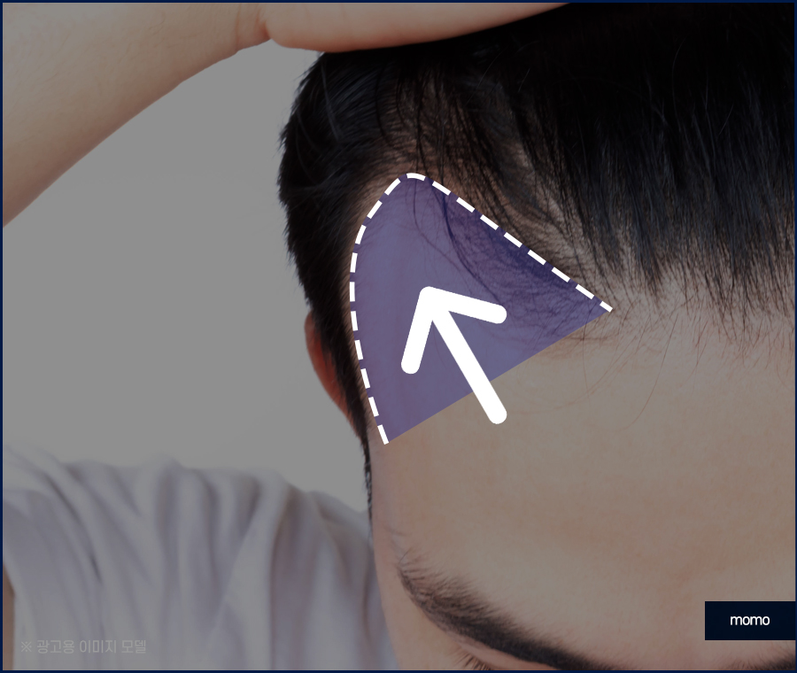 모발이식재수술 원인 파악을 먼저 관련 이미지 8