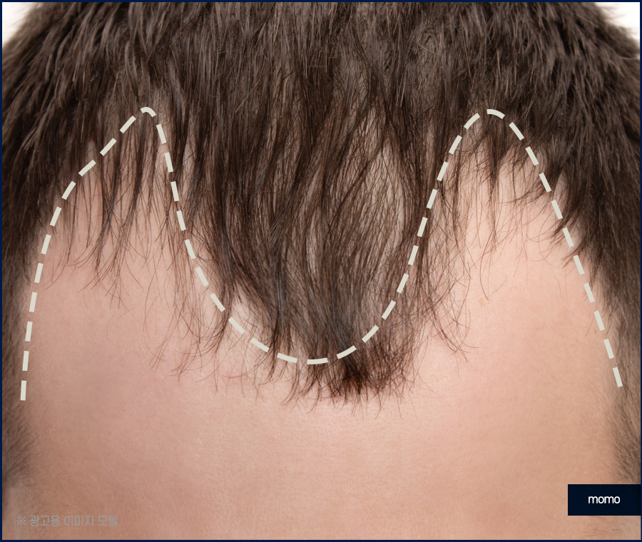 앞머리 모발이식 가격 차이부터 확인하며 관련 이미지 5