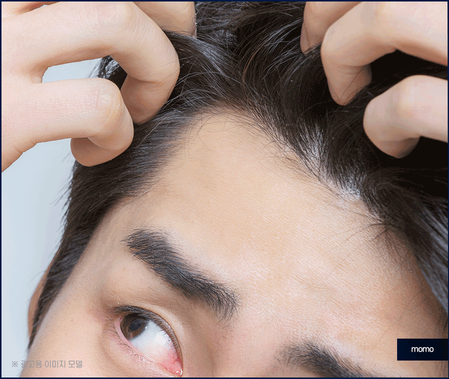 M자탈모치료 모발이식이 특별한 이유 3가지 관련 이미지 2