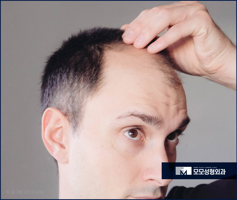 모발이식재수술 용기내서 하는 만큼 관련 이미지 2