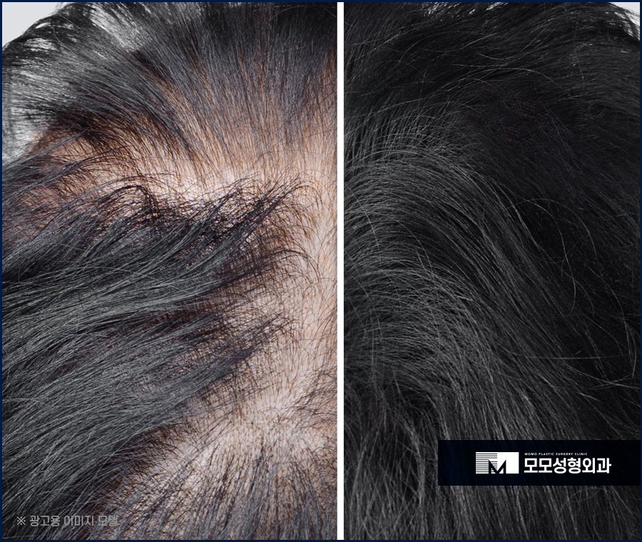 여성정수리모발이식 채워가고자 할 때에는 관련 이미지 3