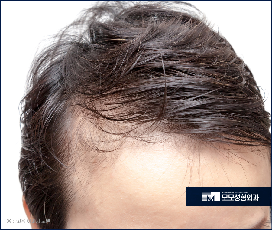 남자 앞머리 탈모 M자 라인 깊어짐이 보인다면 관련 이미지 10