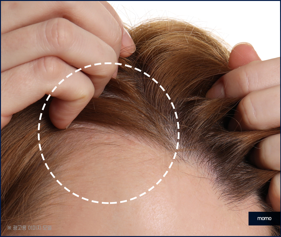 모발이식 후기 비교하며 섬세한 분석까지 해야만 관련 이미지 8