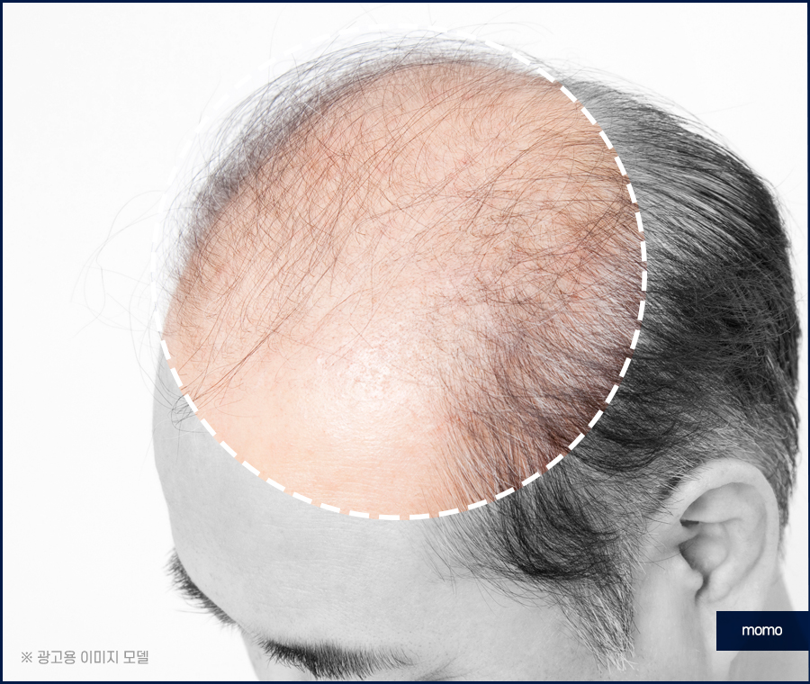 정수리 냄새 제거 원인부터 탁월한 제거 방안까지 관련 이미지 6