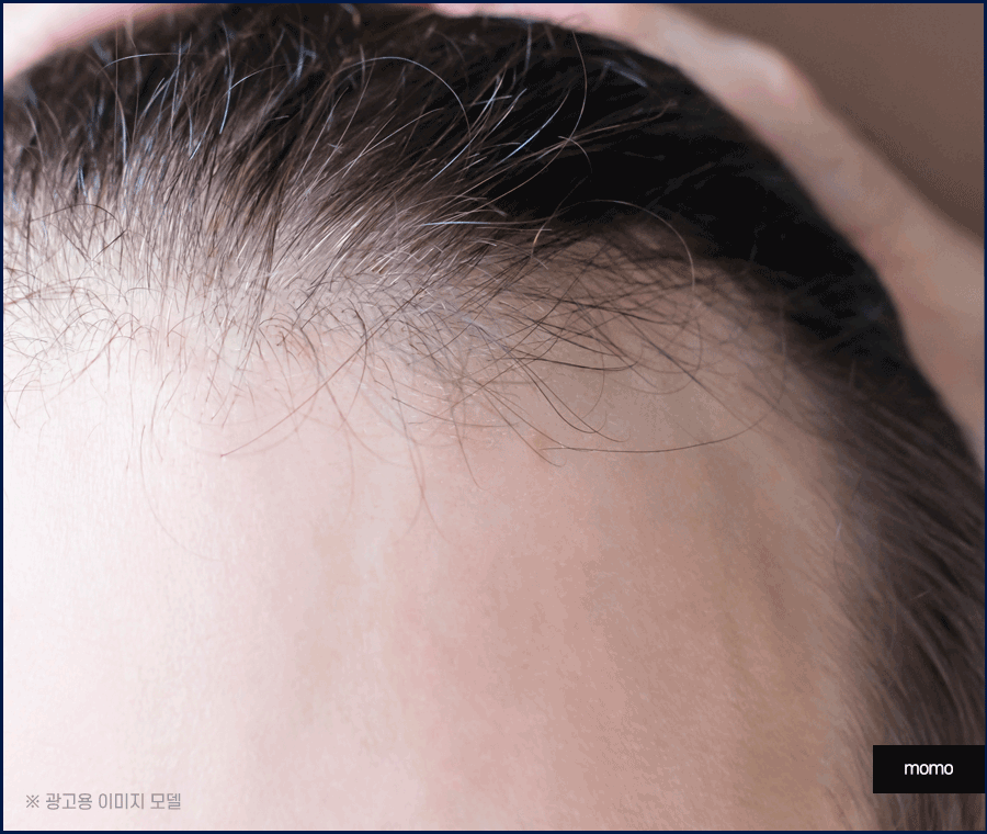 여자M자탈모 회복을 위한 맞춤 솔루션 관련 이미지 7