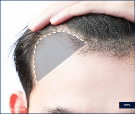 압구정 모발이식 탈모 문제를 해소하는 관련 이미지 8