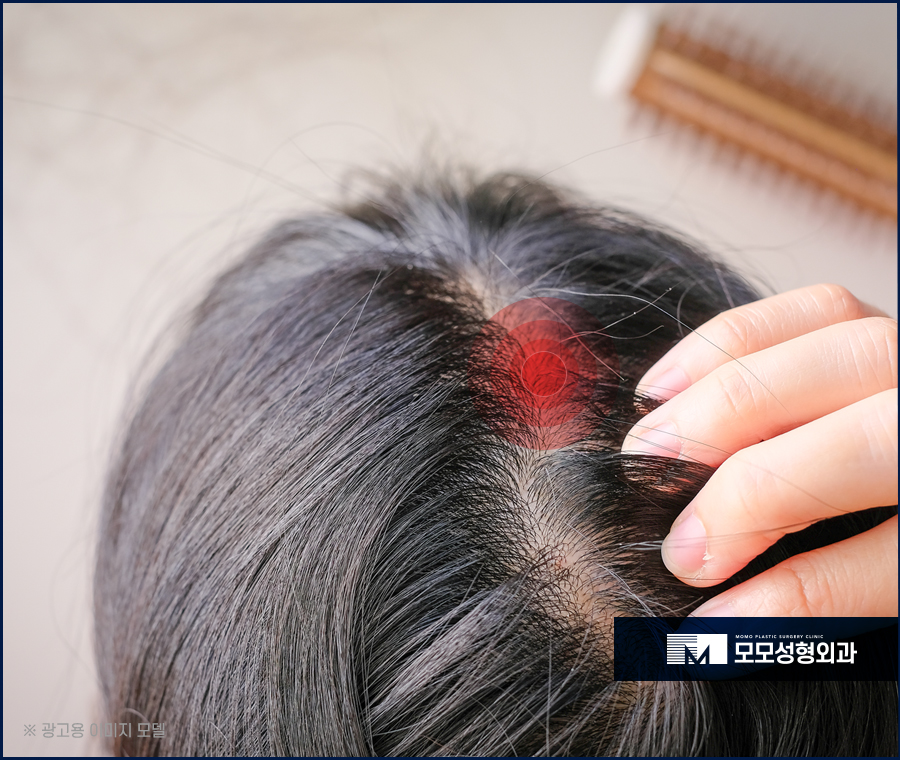 두피모낭염 증세와 해결 방법에 대해 관련 이미지 4