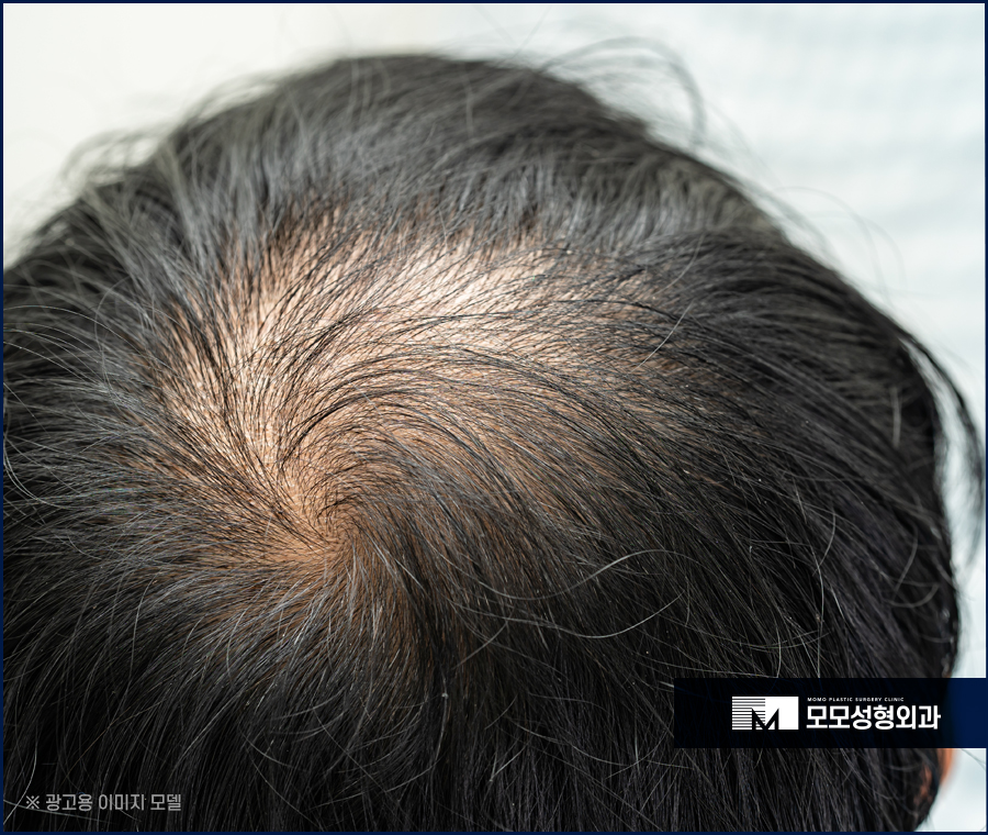 모발이식 3000모 어떤 분들에게 적절할까요 관련 이미지 2