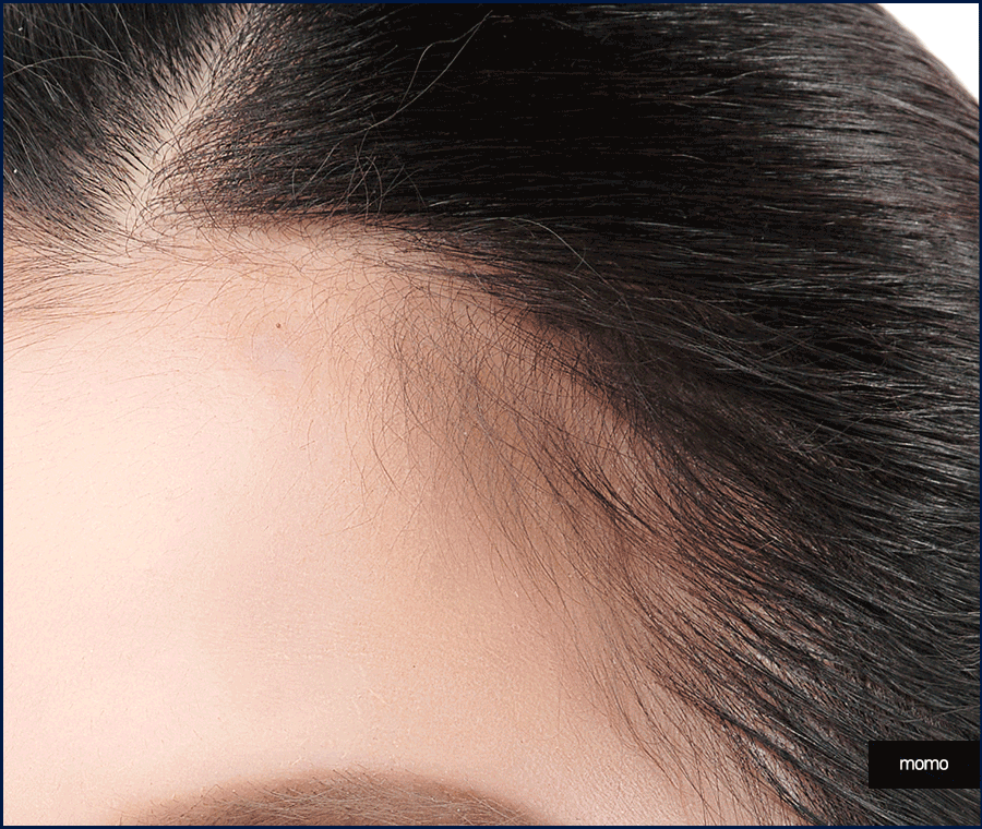 헤어라인 모발이식 비용보다 꼼꼼히 알아볼 조건은? 관련 이미지 6