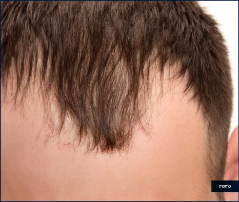 헤어라인 교정 비용 및 방법 디자인의 중요성 관련 이미지 4