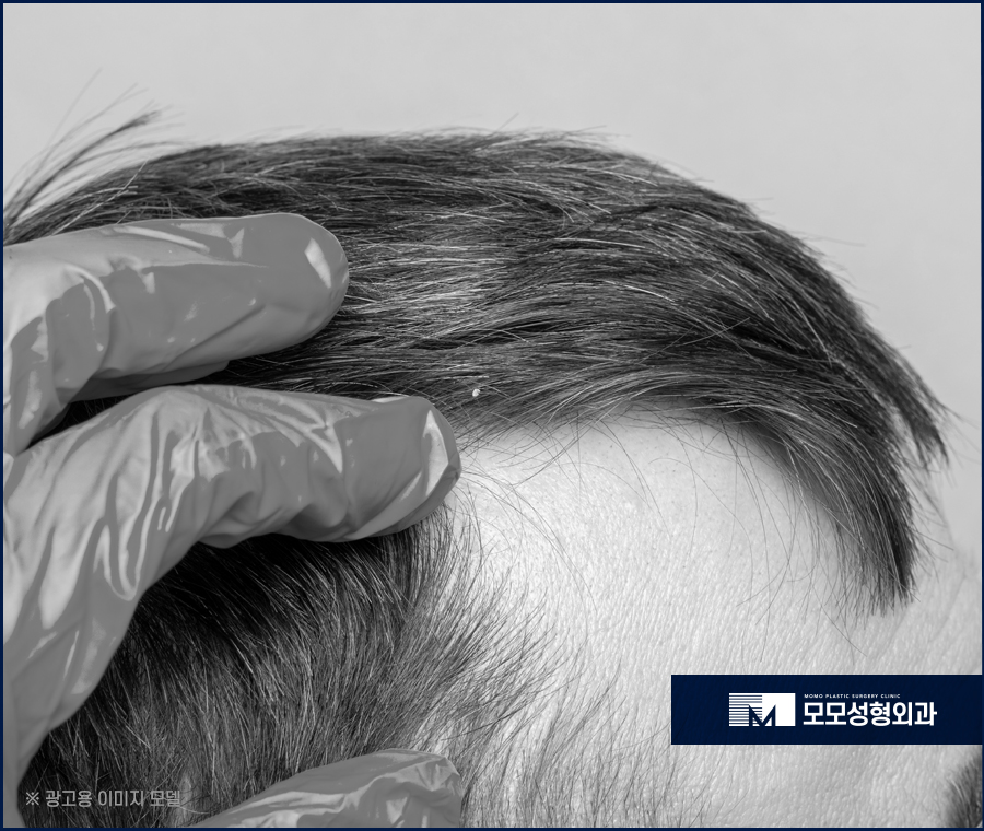 엠자탈모모발이식 안정적인 과정으로 나아가며 관련 이미지 2