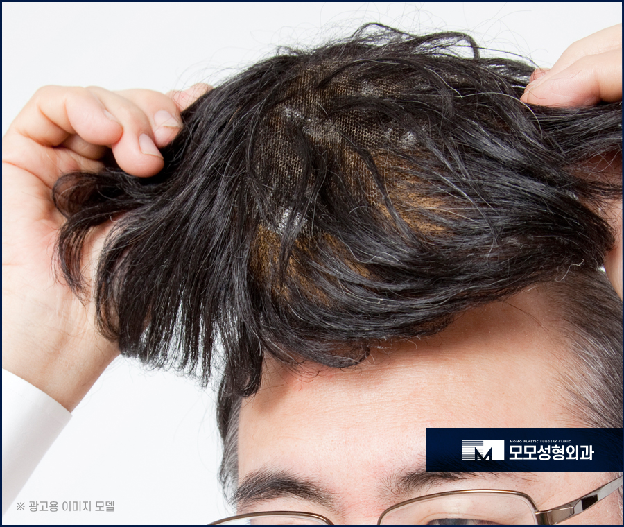 모발이식절개비절개 방식의 차이점 관련 이미지 4