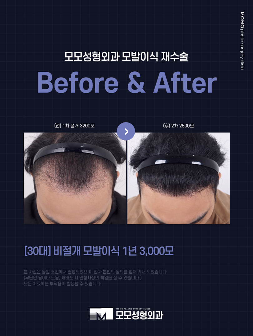 엠자탈모 초기 어떤 증상들이 동반될까요 관련 이미지 3