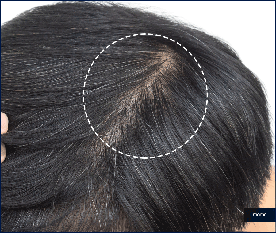 모발이식 2000모 자연스러운 커버 결과 정도는? 관련 이미지 10