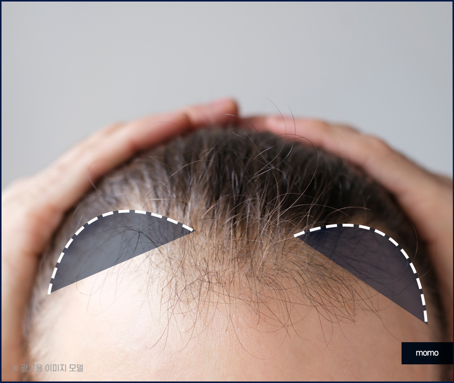여자m자탈모 헤어라인 디자인까지 고려해 채우는 관련 이미지 9