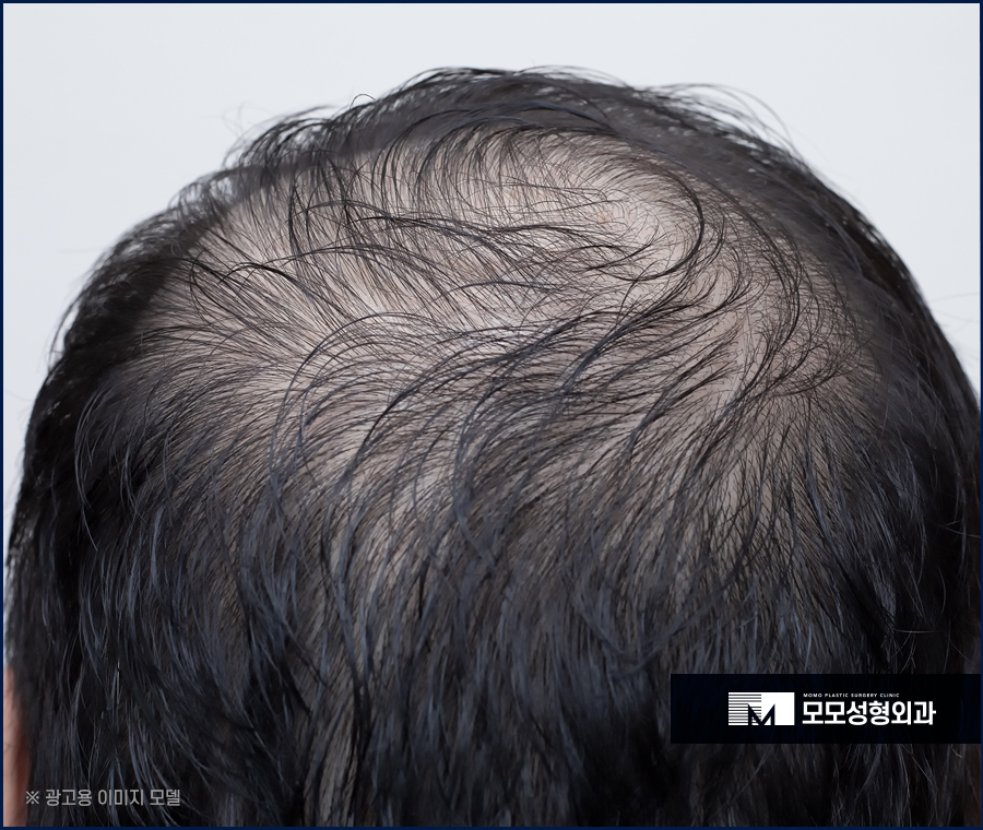 모발이식센터 문제를 개선하는 효과로 관련 이미지 3