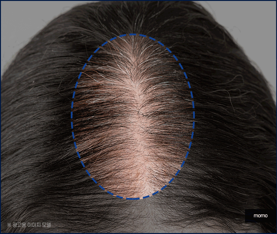 산후 탈모 언제까지 유지되는지 원인 및 대처법 관련 이미지 4