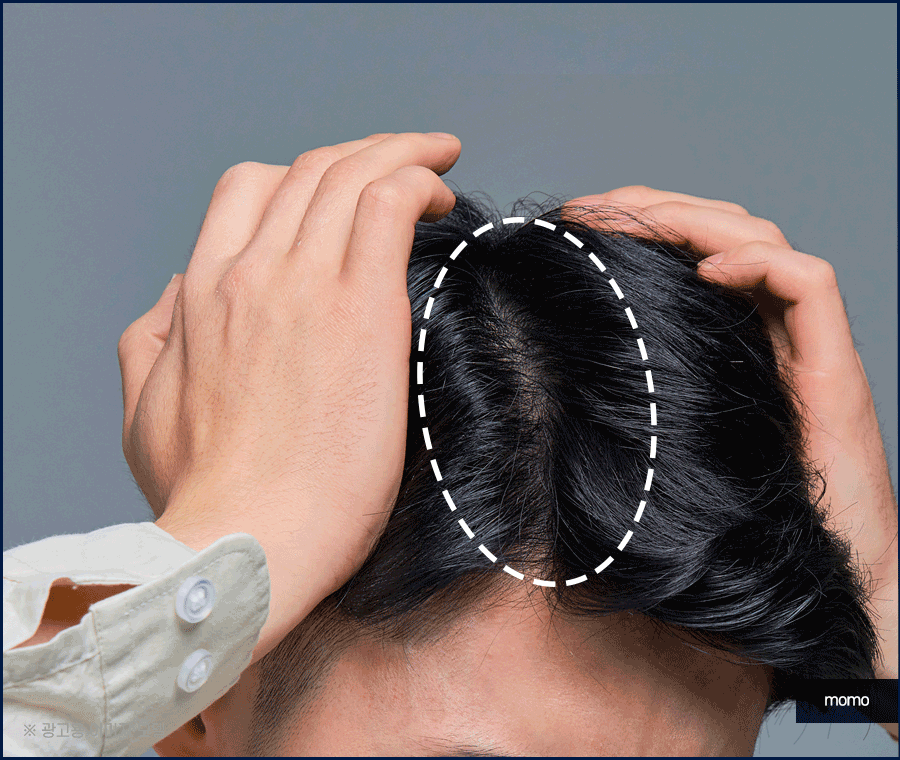 중학생탈모 발생 원인 및 보완하는 방법은? 관련 이미지 4