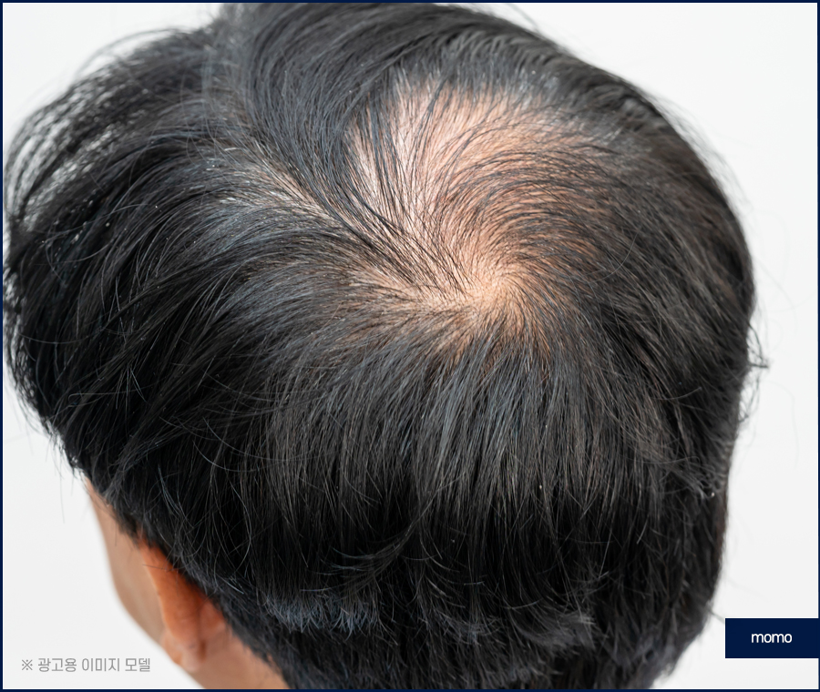 두피열 내리는 법 누구나 쉽게 할 수 있는 관련 이미지 2