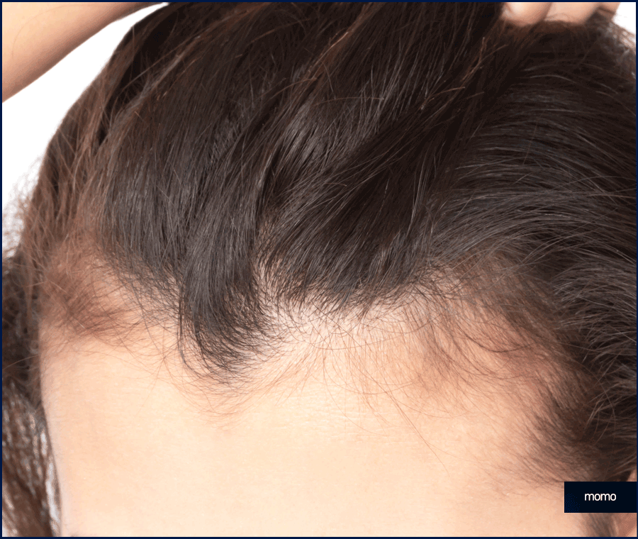 헤어라인 모발이식 비용보다 꼼꼼히 알아볼 조건은? 관련 이미지 5