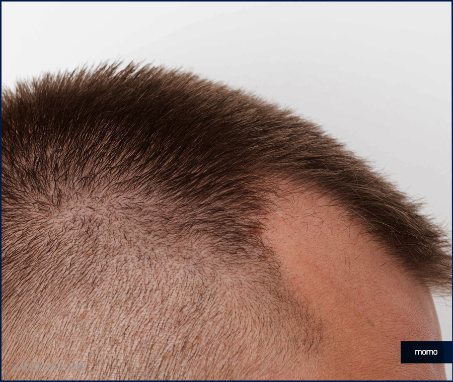 이마 머리 심기 넓은 모습을 보완하기 위한 관련 이미지 4