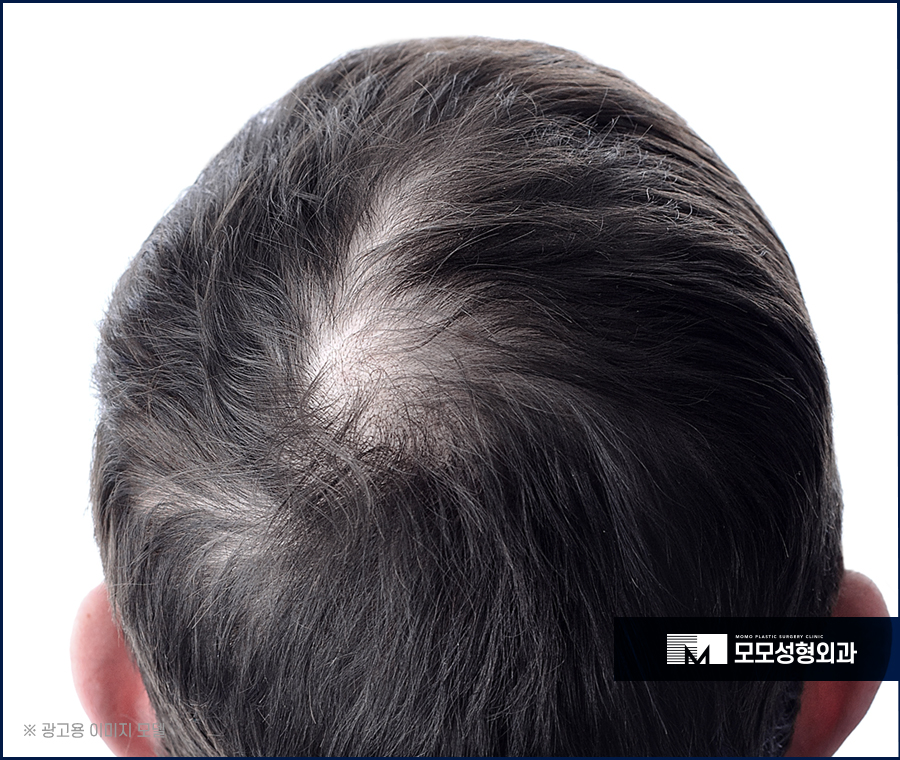강남탈모치료 조건부터 신경 써야만 관련 이미지 4