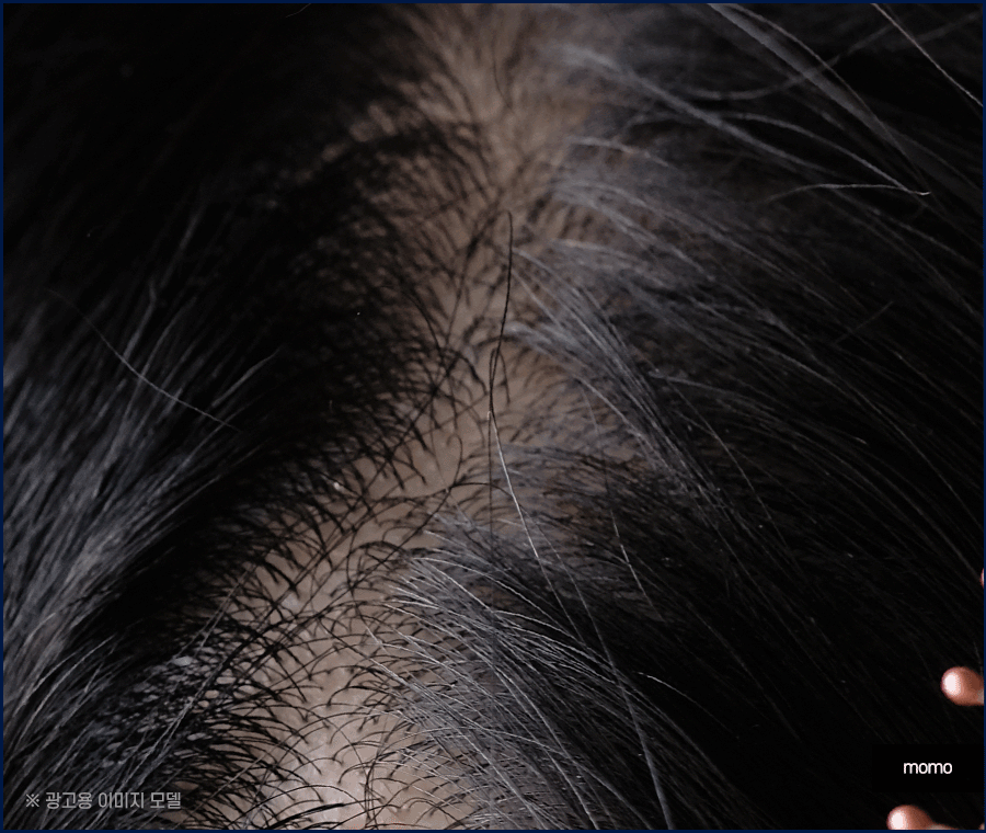 모발이식병원추천 개인에게 맞춰 진단하는 곳으로 관련 이미지 4